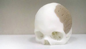 3D tiskalnike se že začenja uporabljati za izdelavo protez, ki so povsem prilagojene pacientom.